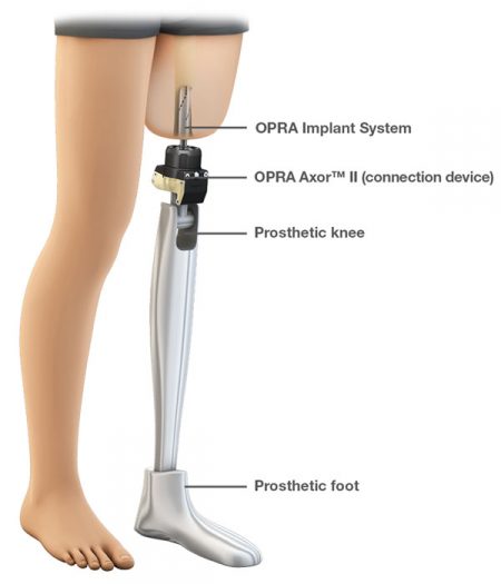 Osseointegration